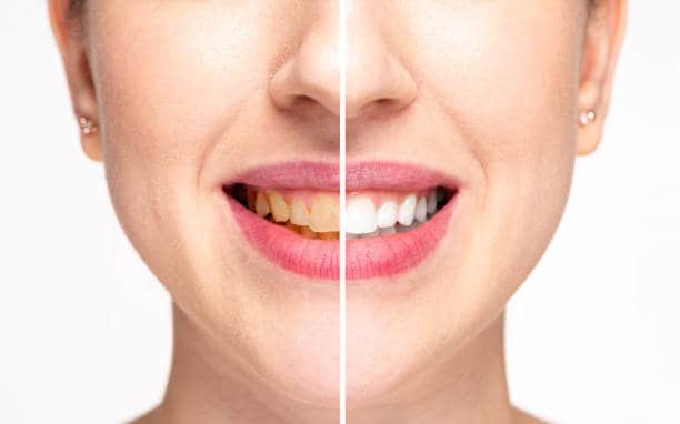 Teeth Whitening Milton Keynes Bracknell