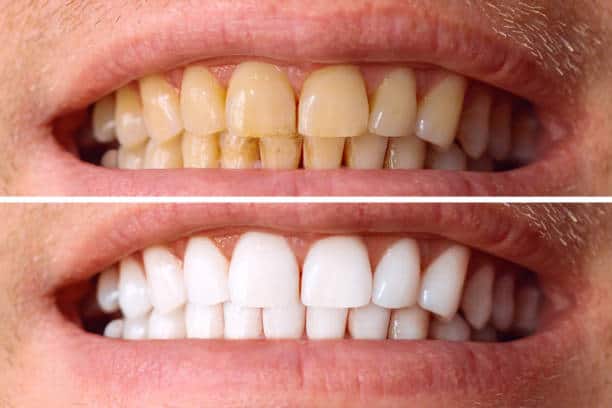 Laser White For Ever Bright – Get a Brighter, Whiter Smile with LA Teeth Whitening Bracknell