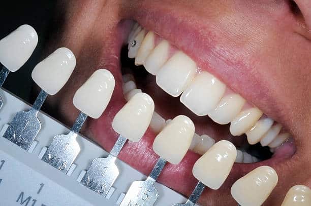 Get Natural and Stunning Smile with Teeth Whitening Results from LA Teeth Whitening Bracknell