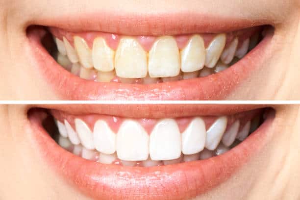 Achieve a Dazzling Smile for Your Special Day: A Guide to Wedding Teeth Whitening Bracknell