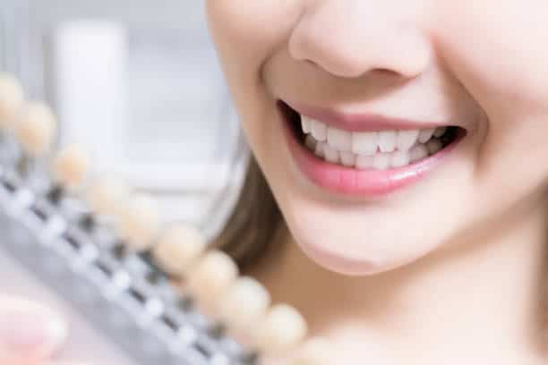 Teeth Whitening Kings Norton Bracknell