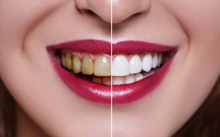 Teeth Whitening Ascot Windsor Bracknell