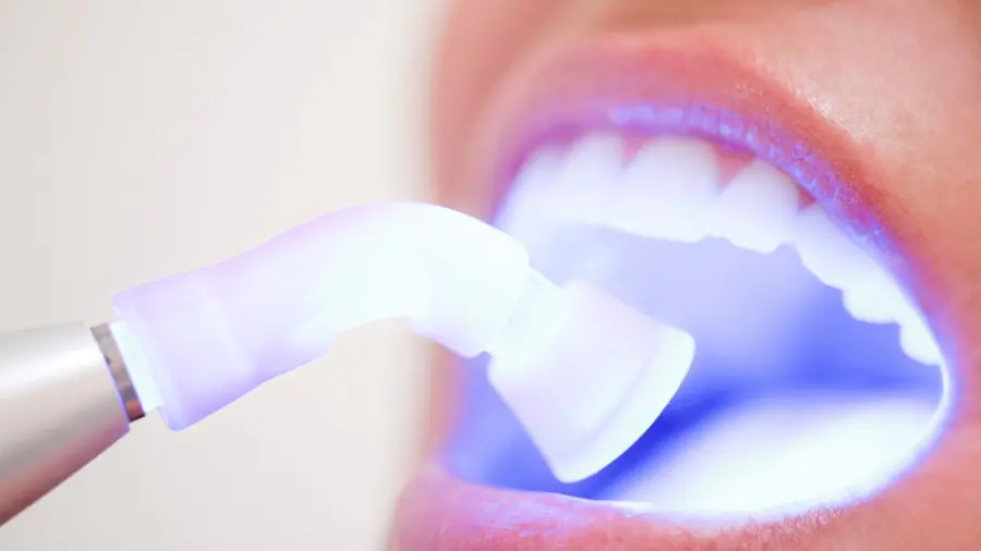 Teeth Whitening Aylesbury Bracknell