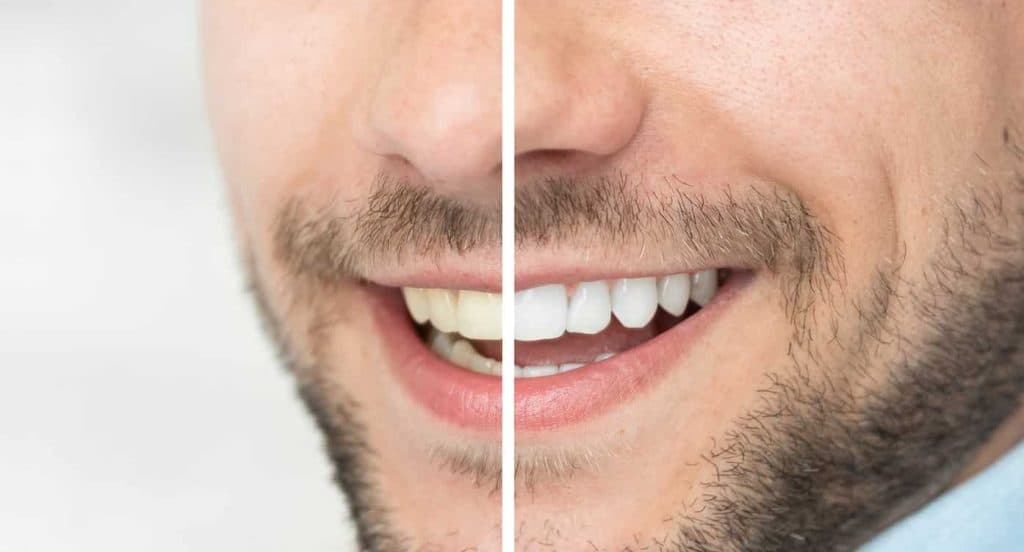 Teeth Whitening Bedfordshire Bracknell