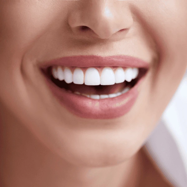 Get A whiter smile fast! Book with LA Teeth Whitening today! Bracknell